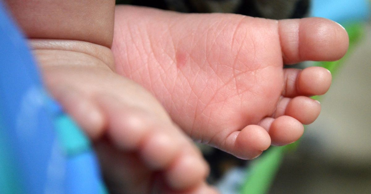 Corrective Shoes vs. Casting: Which Metatarsus Adductus Treatment Is Really Best for Toddlers?